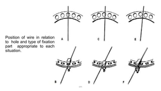 Position of wire in relation
to hole and type of fixation
part appropriate to each
situation.
DPS
 