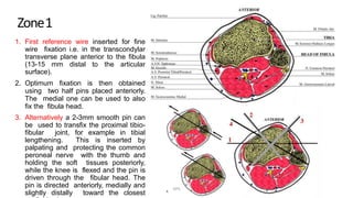 Zone1
1. First reference wire inserted for fine
wire fixation i.e. in the transcondylar
transverse plane anterior to the fibula
(13-15 mm distal to the articular
surface).
2. Optimum fixation is then obtained
using two half pins placed anteriorly.
The medial one can be used to also
fix the fibula head.
3. Alternatively a 2-3mm smooth pin can
be used to transfix the proximal tibio-
fibular joint, for example in tibial
lengthening. This is inserted by
palpating and protecting the common
peroneal nerve with the thumb and
holding the soft tissues posteriorly,
while the knee is flexed and the pin is
driven through the fibular head. The
pin is directed anteriorly, medially and
slightly distally toward the closest
DPS
 