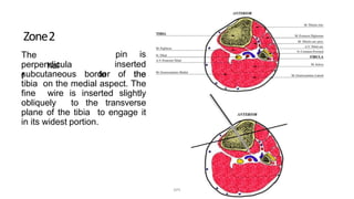 Zone2
The
hal
f
perpendicula
r
pin is
inserted
to thesubcutaneous border of the
tibia on the medial aspect. The
fine wire is inserted slightly
obliquely to the transverse
plane of the tibia to engage it
in its widest portion.
DPS
 