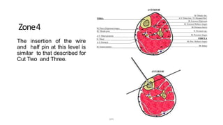 Zone4
The insertion of the wire
and half pin at this level is
similar to that described for
Cut Two and Three.
DPS
 