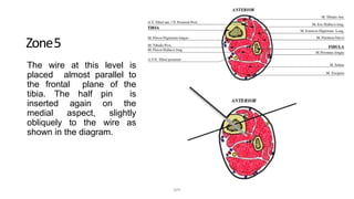 Zone5
The wire at this level is
placed almost parallel to
the frontal plane of the
tibia. The half pin is
inserted again on the
medial aspect, slightly
obliquely to the wire as
shown in the diagram.
DPS
 