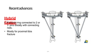 Recentadvances
Hybrid
fixator-• Proximal ring connected to 2 or
3 pins distally with connecting
rods.
• Mostly for proximal tibia
fracture
DPS
 