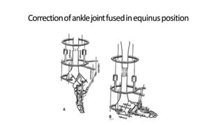 Correctionofanklejointfusedinequinusposition
DPS
 