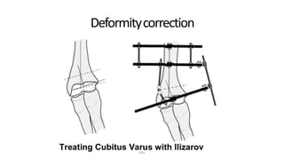 Deformitycorrection
DPS
 