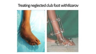 TreatingneglectedclubfootwithIlizarov
DPS
 