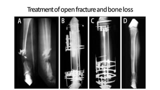 Treatmentofopenfractureandboneloss
DPS
 
