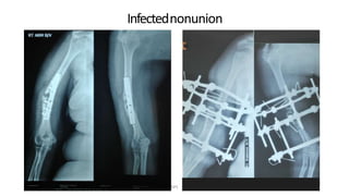 Infectednonunion
DPS
 