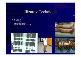 Ilizarov Technique 
• Cong 
pseudarth….. 
Dr Saleh W Alharby 
alharby@ksu.edu..sa 
http:/faculty.ksu.edu.sa/DrSalehAlharby 
 