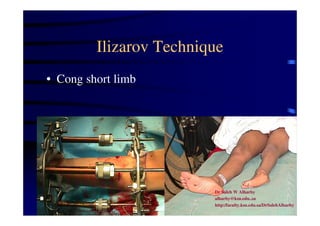 Ilizarov Technique 
• Cong short limb 
Dr Saleh W Alharby 
alharby@ksu.edu..sa 
http:/faculty.ksu.edu.sa/DrSalehAlharby 
 