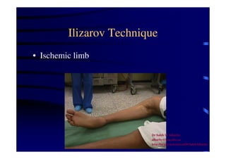 Ilizarov Technique 
• Ischemic limb 
Dr Saleh W Alharby 
alharby@ksu.edu..sa 
http:/faculty.ksu.edu.sa/DrSalehAlharby 
 