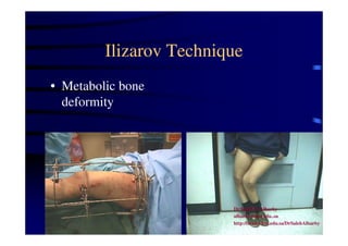 Ilizarov Technique 
• Metabolic bone 
deformity 
Dr Saleh W Alharby 
alharby@ksu.edu..sa 
http:/faculty.ksu.edu.sa/DrSalehAlharby 
 