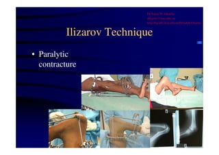 Ilizarov Technique 
• Paralytic 
contracture 
Dr Saleh W Alharby 
alharby@ksu.edu..sa 
http:/faculty.ksu.edu.sa/DrSalehAlharby 
 