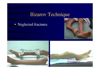 Ilizarov Technique 
• Neglected fractures 
Dr Saleh W Alharby 
alharby@ksu.edu..sa 
http:/faculty.ksu.edu.sa/DrSalehAlharby 
 