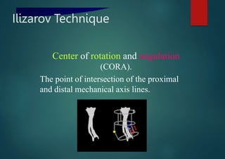 ilizarov technique.pptx