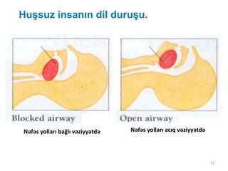 12
Huşsuz insanın dil duruşu.
Nəfəs yolları bağlı vəziyyətdə Nəfəs yolları acıq vəziyyətdə
 