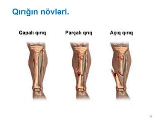 Qırığın növləri.
34
Qapalı qırıq Parçalı qrıq Açıq qırıq
 