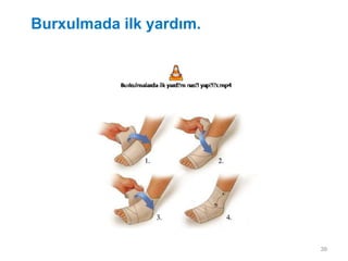 Burxulmada ilk yardım.
39
 