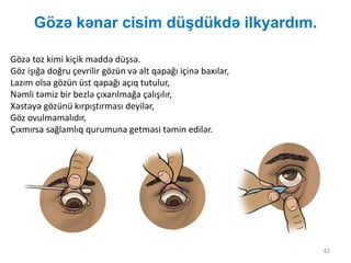 Gözə kənar cisim düşdükdə ilkyardım.
42
Gözə toz kimi kiçik maddə düşsə.
Göz işığa doğru çevrilir gözün və alt qapağı içinə baxılar,
Lazım olsa gözün üst qapağı açıq tutulur,
Nəmli təmiz bir bezlə çıxarılmağa çalışılır,
Xəstəyə gözünü kırpıştırması deyilər,
Göz ovulmamalıdır,
Çıxmırsa sağlamlıq qurumuna getməsi təmin edilər.
 