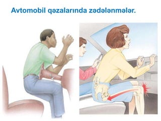 Avtomobil qəzalarında zədələnmələr.
59
 