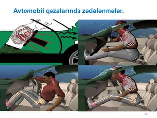 Avtomobil qəzalarında zədələnmələr.
60
 