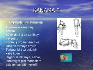 KANAMA 3 Kopmalar ve Kanama Turnikeyle kanamayı azaltın. 20 dk da 2-3 dk turnikeyi gevşetin. Kopmuş organı temiz ve kuru bir torbaya koyun. Torbayı içi buz dolu bir kaba koyun. Organı direk suya, alkole, tentürdiyot gibi maddelere  asla temas ettirmeyin!!! 