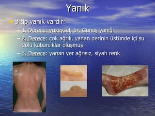 Yanık 3 tip yanık vardır: 1. Derece : yüzeysel, ör. Güneş yanığı 2. Derece : çok ağrılı, yanan derinin üstünde içi su dolu kabarcıklar oluşmuş 3. Derece : yanan yer ağrısız, siyah renk 