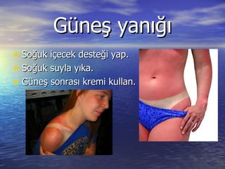 Güneş yanığı Soğuk içecek desteği yap. Soğuk suyla yıka. Güneş sonrası kremi kullan. 