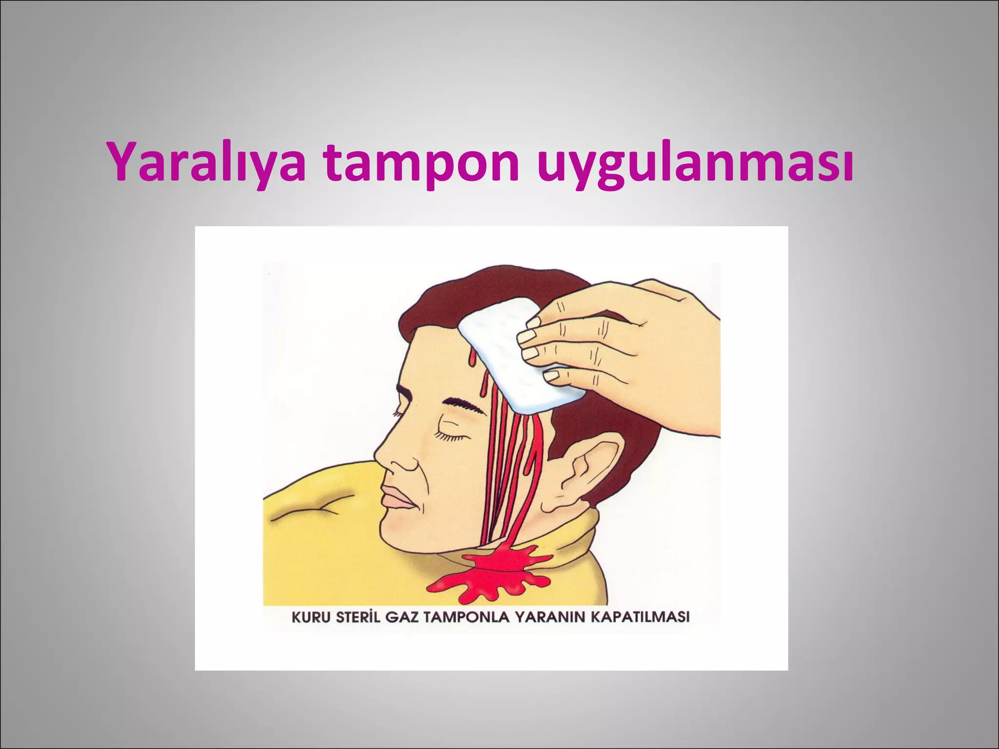 Yaralıya tampon uygulanması 
