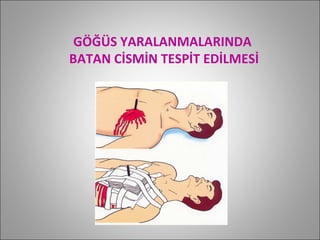 GÖĞÜS YARALANMALARINDA  BATAN CİSMİN TESPİT EDİLMESİ 