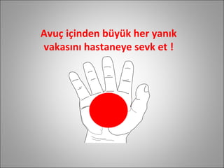 Avuç içinden büyük her yanık vakasını hastaneye sevk et ! 