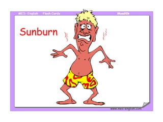 Sunburn 
 