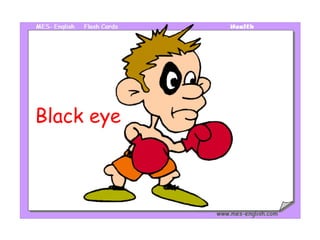 Black eye 
