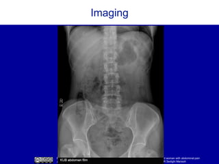 Based on Jones B, Brzezinski WA, Estrada CA, Rodriguez M, Kraemer RR. A 22-year-old woman with abdominal pain
J Gen Intern Med. 2014 Jul;29(7):1074-8’ Created by R Geha, DM Connor, J Kohlwes, R Sedighi Manesh
Imaging
 