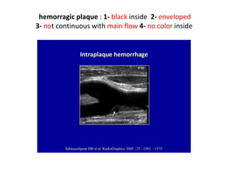hemorragic plaque : 1- black inside 2- enveloped
3- not continuous with main flow 4- no color inside
 