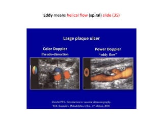 Eddy means helical flow (spiral) slide (35)
 