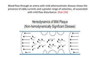 Blood flow through an artery with mild atherosclerotic disease shows the
presence of eddy currents and a greater range of velocities, all associated
with mild flow disturbance. Slide (34)
 