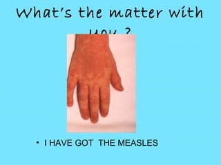 What’s the matter with
you ?
• I HAVE GOT THE MEASLES
 