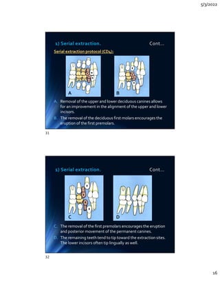 5/3/2022
16
Serial extraction protocol (CD4):
A. Removal of the upper and lower deciduous canines allows
for an improvement in the alignment of the upper and lower
incisors.
B. The removal of the deciduous first molars encourages the
eruption of the first premolars.
Serial extraction protocol (CD4):
A. Removal of the upper and lower deciduous canines allows
for an improvement in the alignment of the upper and lower
incisors.
B. The removal of the deciduous first molars encourages the
eruption of the first premolars.
1) Serial extraction. Cont…
A B
1) Serial extraction. Cont…
C. The removal of the first premolars encourages the eruption
and posterior movement of the permanent canines.
D. The remaining teeth tend to tip toward the extraction sites.
The lower incisors often tip lingually as well.
C. The removal of the first premolars encourages the eruption
and posterior movement of the permanent canines.
D. The remaining teeth tend to tip toward the extraction sites.
The lower incisors often tip lingually as well.
C D
31
32
 