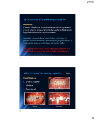 5/3/2022
19
2) Correction of developing crossbite.
Definition:
Anterior cross bite is a condition characterized by reverse
overjet wherein one or more maxillary anterior teeth are in
lingual relation to the mandibular teeth.
Should be intercepted and treated at an early stage to
prevent a minor orthodontic problem from progressing into a
major dento-facial anomaly.as an old maxim states
“The best time to treat a crossbite is the first time it is
seen” Or else it may grow into skeletal malocclusion
Definition:
Anterior cross bite is a condition characterized by reverse
overjet wherein one or more maxillary anterior teeth are in
lingual relation to the mandibular teeth.
Should be intercepted and treated at an early stage to
prevent a minor orthodontic problem from progressing into a
major dento-facial anomaly.as an old maxim states
“The best time to treat a crossbite is the first time it is
seen” Or else it may grow into skeletal malocclusion
2) Correction of developing crossbite. Cont…
Classification:
1. Dento-alveolar
2. Skeletal
3. Functional
Classification:
1. Dento-alveolar
2. Skeletal
3. Functional Dento-alveolar
Functional
Skeletal
37
38
 