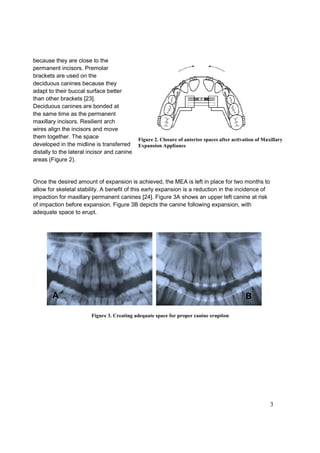 3
because they are close to the
permanent incisors. Premolar
brackets are used on the
deciduous canines because they
adapt to their buccal surface better
than other brackets [23].
Deciduous canines are bonded at
the same time as the permanent
maxillary incisors. Resilient arch
wires align the incisors and move
them together. The space
developed in the midline is transferred
distally to the lateral incisor and canine
areas (Figure 2).
Once the desired amount of expansion is achieved, the MEA is left in place for two months to
allow for skeletal stability. A benefit of this early expansion is a reduction in the incidence of
impaction for maxillary permanent canines [24]. Figure 3A shows an upper left canine at risk
of impaction before expansion. Figure 3B depicts the canine following expansion, with
adequate space to erupt.
Figure 3. Creating adequate space for proper canine eruption
Figure 2. Closure of anterior spaces after activation of Maxillary
Expansion Appliance
A B
 