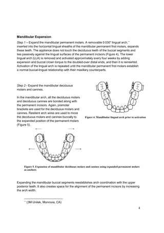 4
Mandibular Expansion
Step 1 – Expand the mandibular permanent molars. A removable 0.030” lingual arch,∗∗
inserted into the horizontal lingual sheaths of the mandibular permanent first molars, expands
these teeth. The appliance does not touch the deciduous teeth of the buccal segments and
lies passively against the lingual surfaces of the permanent incisors (Figure 4). The lower
lingual arch (LLA) is removed and activated approximately every four weeks by adding
expansion and buccal crown torque to the doubled-over distal ends, and then it is reinserted.
Activation of the lingual arch is repeated until the mandibular permanent first molars establish
a normal buccal-lingual relationship with their maxillary counterparts.
Step 2 - Expand the mandibular deciduous
molars and canines.
In the mandibular arch, all the deciduous molars
and deciduous canines are bonded along with
the permanent incisors. Again, premolar
brackets are used for the deciduous molars and
canines. Resilient arch wires are used to move
the deciduous molars and canines buccally to
the expanded position of the permanent molars
(Figure 5).
Figure 5. Expansion of mandibular deciduous molars and canines using expanded permanent molars
as anchors
Expanding the mandibular buccal segments reestablishes arch coordination with the upper
posterior teeth. It also creates space for the alignment of the permanent incisors by increasing
the arch width.
∗∗
(3M Unitek, Monrovia, CA)
Figure 4. Mandibular lingual arch prior to activation
 