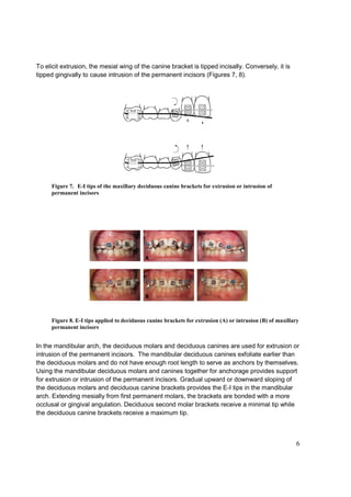 6
To elicit extrusion, the mesial wing of the canine bracket is tipped incisally. Conversely, it is
tipped gingivally to cause intrusion of the permanent incisors (Figures 7, 8).
Figure 7. E-I tips of the maxillary deciduous canine brackets for extrusion or intrusion of
permanent incisors
Figure 8. E-I tips applied to deciduous canine brackets for extrusion (A) or intrusion (B) of maxillary
permanent incisors
In the mandibular arch, the deciduous molars and deciduous canines are used for extrusion or
intrusion of the permanent incisors. The mandibular deciduous canines exfoliate earlier than
the deciduous molars and do not have enough root length to serve as anchors by themselves.
Using the mandibular deciduous molars and canines together for anchorage provides support
for extrusion or intrusion of the permanent incisors. Gradual upward or downward sloping of
the deciduous molars and deciduous canine brackets provides the E-I tips in the mandibular
arch. Extending mesially from first permanent molars, the brackets are bonded with a more
occlusal or gingival angulation. Deciduous second molar brackets receive a minimal tip while
the deciduous canine brackets receive a maximum tip.
 