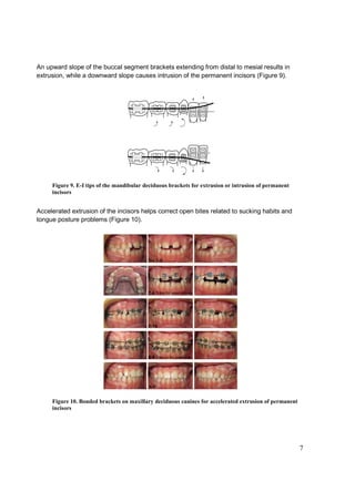 7
An upward slope of the buccal segment brackets extending from distal to mesial results in
extrusion, while a downward slope causes intrusion of the permanent incisors (Figure 9).
Figure 9. E-I tips of the mandibular deciduous brackets for extrusion or intrusion of permanent
incisors
Accelerated extrusion of the incisors helps correct open bites related to sucking habits and
tongue posture problems (Figure 10).
Figure 10. Bonded brackets on maxillary deciduous canines for accelerated extrusion of permanent
incisors
 