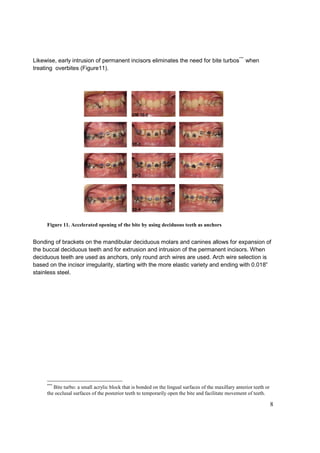 8
Likewise, early intrusion of permanent incisors eliminates the need for bite turbos***
when
treating overbites (Figure11).
Figure 11. Accelerated opening of the bite by using deciduous teeth as anchors
Bonding of brackets on the mandibular deciduous molars and canines allows for expansion of
the buccal deciduous teeth and for extrusion and intrusion of the permanent incisors. When
deciduous teeth are used as anchors, only round arch wires are used. Arch wire selection is
based on the incisor irregularity, starting with the more elastic variety and ending with 0.018”
stainless steel.
***
Bite turbo: a small acrylic block that is bonded on the lingual surfaces of the maxillary anterior teeth or
the occlusal surfaces of the posterior teeth to temporarily open the bite and facilitate movement of teeth.
 