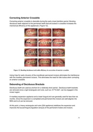 9
Correcting Anterior Crossbite
Correcting anterior crossbite is desirable during the early mixed dentition period. Bonding
deciduous teeth adjacent to the permanent teeth that are locked in crossbite increases the
mechanical efficiency of the appliances ( Figure 12).
Figure 12. Bonding deciduous teeth adds efficiency in correction of anterior crossbite
Using I-tips for early intrusion of the mandibular permanent incisors eliminates the interference
with the maxillary permanent incisors. This eliminates the need for bite turbos when correcting
an anterior crossbite.
Debonding of Deciduous Brackets
Deciduous teeth are used as anchors for a relatively short period. Deciduous teeth brackets
are removed once a rigid rectangular arch wire, such as .017”X.022”, can be engaged in the
incisor region.
A maxillary expansion appliance and a lower lingual arch are generally used for less than six
months. Once the expansion is completed and permanent the incisors are well aligned, the
MEA and LLA can be removed.
At this point, a heavy rectangular arch wire (2X4 appliance) stabilizes the expansion and
improves the buccal-lingual angulation (torque) of the permanent molars and incisors.
 