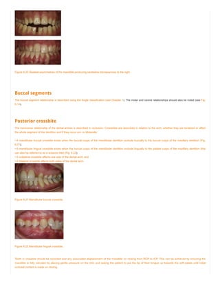Figure 6.20 Skeletal asymmetries of the mandible producing centreline discrepancies to the right.
Buccal segments
The buccal segment relationship is described using the Angle classification (see Chapter 1). The molar and canine relationships should also be noted (see Fig.
6.14).
Posterior crossbite
The transverse relationship of the dental arches is described in occlusion. Crossbites are described in relation to the arch, whether they are localized or affect
the whole segment of the dentition and if they occur uni- or bilaterally:
• A mandibular buccal crossbite exists when the buccal cusps of the mandibular dentition occlude buccally to the buccal cusps of the maxillary dentition (Fig.
6.21);
• A mandibular lingual crossbite exists when the buccal cusps of the mandibular dentition occlude lingually to the palatal cusps of the maxillary dentition (this
can also be referred to as a scissors bite) (Fig. 6.22);
• A unilateral crossbite affects one side of the dental arch; and
• A bilateral crossbite affects both sides of the dental arch.
Figure 6.21 Mandibular buccal crossbite.
Figure 6.22 Mandibular lingual crossbite.
Teeth in crossbite should be recorded and any associated displacement of the mandible on closing from RCP to ICP. This can be achieved by ensuring the
mandible is fully retruded by placing gentle pressure on the chin and asking the patient to put the tip of their tongue up towards the soft palate until initial
occlusal contact is made on closing.
 