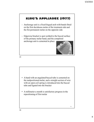 5/3/2022
8
KING’S APPLIANCE (1977)
- Anchorage unit is a fixed lingual arch with bands fitted
on the first deciduous molar of the treatment side and
the fist permanent molar on the opposite side
- Edgewise bracket is spot welded to the buccal surface
of the primary molar band, and the completed
anchorage unit is cemented in place
15
• A band with an angulated buccal tube is cemented on
the malpositioned molar, and a straight section of wire
with an open coil spring is introduced into the buccal
tube and ligated into the bracket
• A millimeter a month is satisfactory progress in the
repositioning of first molar
16
15
16
 