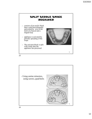 5/3/2022
12
SPLIT SADDLE SPACE
REGAINER
- consists of an acrylic block
that is split buccolingually
and joined by wire in the
form of a buccal and a
lingual loop
- appliance is activated by
periodic spreading of the
loops
- The activator block is split
with a disk after the
appliance has processed
23
- Using canine retractors,
using screws, quad helix
24
23
24
 