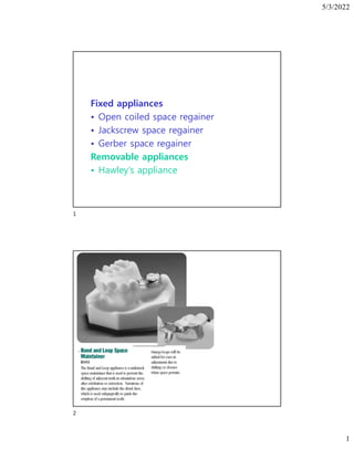 5/3/2022
1
Fixed appliances
• Open coiled space regainer
• Jackscrew space regainer
• Gerber space regainer
Removable appliances
• Hawley’s appliance
1
2
 