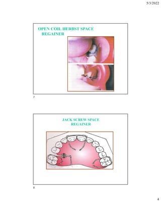 5/3/2022
4
OPEN COIL HERBST SPACE
REGAINER
JACK SCREW SPACE
REGAINER
7
8
 